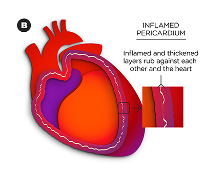 Inflamed-Pericardium_labeled