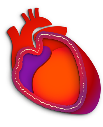 Definition of pericarditis image - swollen, inflamed pericardium