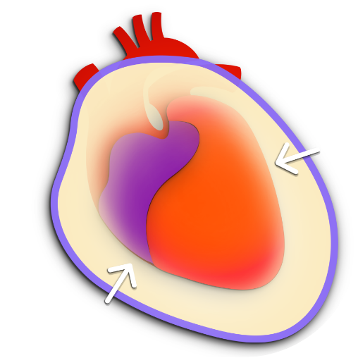 Cardiac tamponade graphic