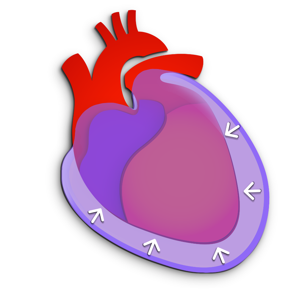Pericardial effusion graphic
