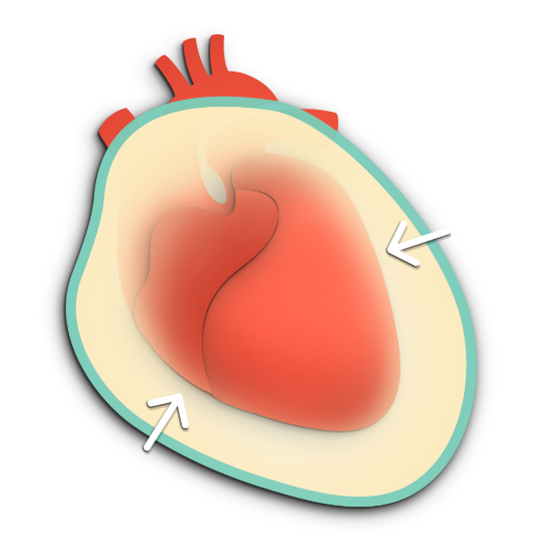 Pericardial effusion is the build up of fluid in the pericardium.