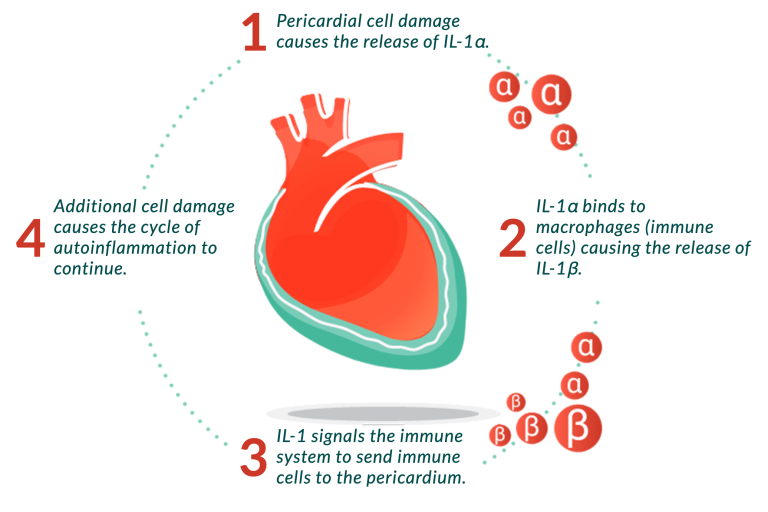 1. Pericardial cell damage causes the release of IL-1alpha. 2. IL-1alpha binds to macrophages (immune cells) causing the release of IL-1beta. 3. IL-1 signals the immune system to send immune cells to the pericardium. 4. Additional cell damage causes the cycle of autoinflammation to continue.