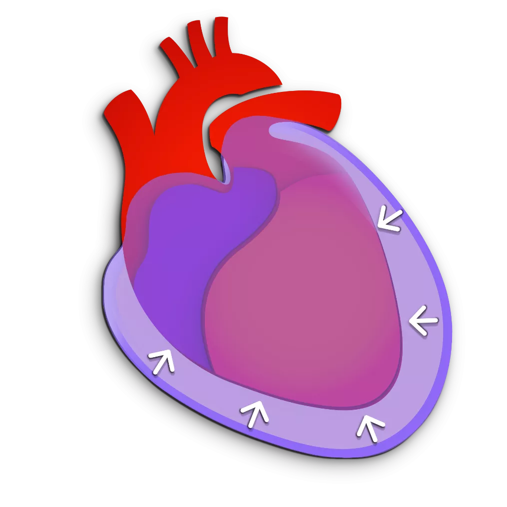 Pericardial effusion graphic